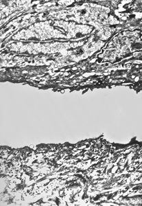 M, 1y. | epidermolysis bullosa … junctional type M, 1y. | epidermolysis bullosa … junctional type
